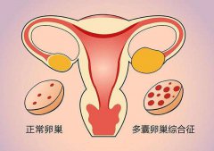 多囊卵巢综合症促排后可以怀孕吗？