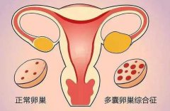 多囊患者做试管婴儿要注意什么？多囊患者可以做试管吗？