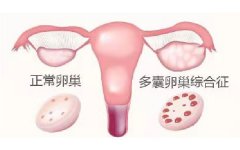 患有多囊可以怀孕吗？医生说：怀孕几率远远低于健康女性